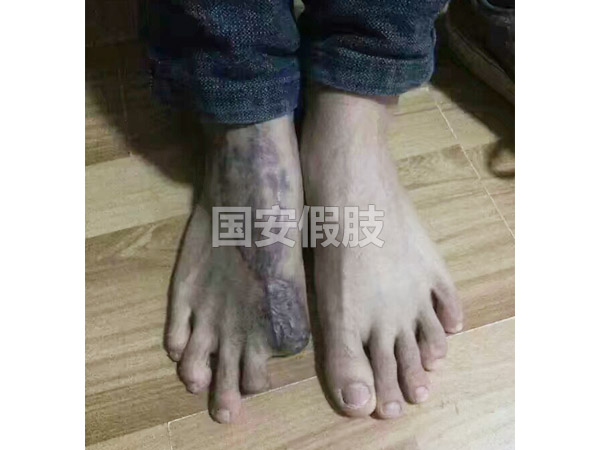 長(zhǎng)沙國(guó)安假肢康復(fù)用品有限公司,長(zhǎng)沙假肢用品,國(guó)安假肢康復(fù)用品,假肢矯形器,康復(fù)器材,假肢配件,矯形器支具