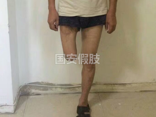 長(zhǎng)沙國安假肢康復(fù)用品有限公司,長(zhǎng)沙假肢用品,國安假肢康復(fù)用品,假肢矯形器,康復(fù)器材,假肢配件,矯形器支具